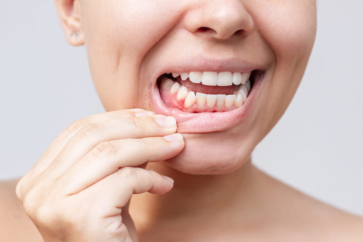 Can gum disease affect your smile the aesthetic impacts of poor oral health blog